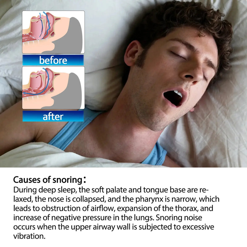 Nasal Strips for Snoring Relief & Better Sleep Aid
